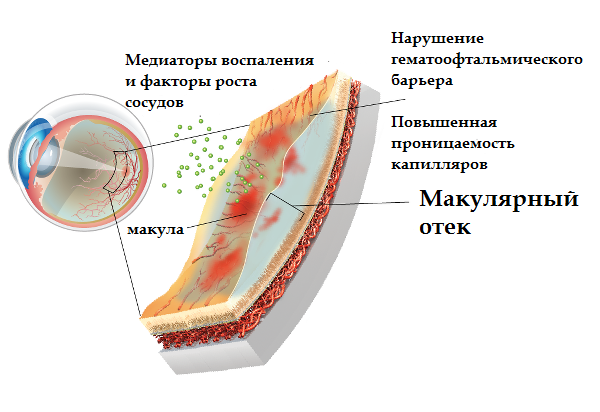 макулярный отек сетчатка