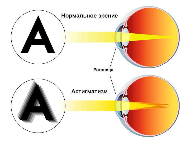 астигматизм лечение