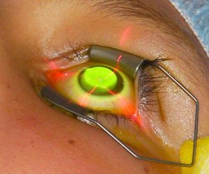 лечение роговицы глаза