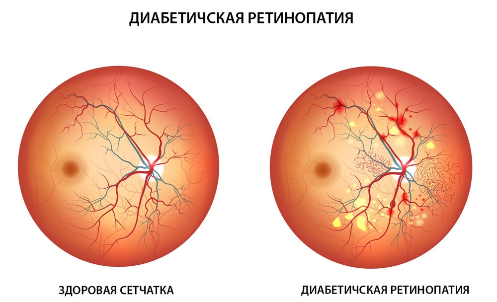 диабет глаза