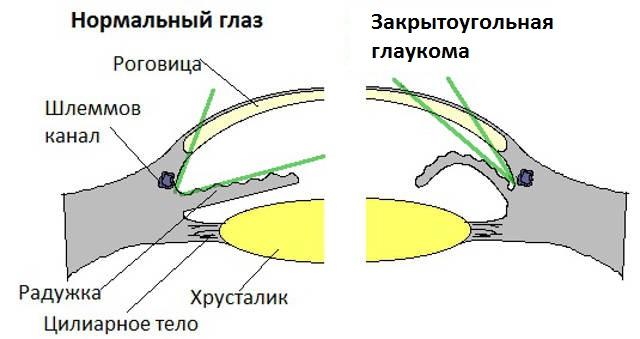 Глаукома лечение