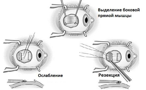 операция косоглазия