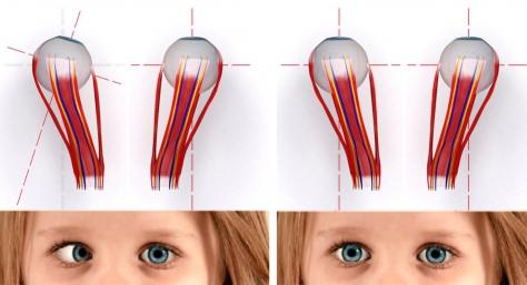 косоглазие у детей
