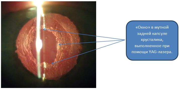Вторичная катаракта