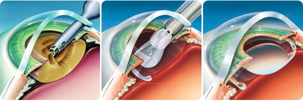 замена хрусталика при катаракте