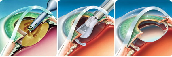 Лечение катаракты